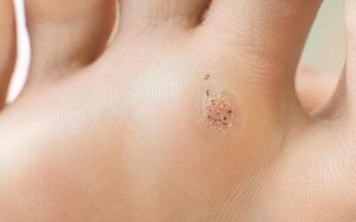 Kurzajki na stopach – jak się ich skutecznie pozbyć?