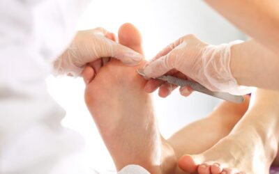 Usuwanie odcisków na stopach – jak robi to podolog?