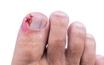 Wrastający paznokieć – jak może pomóc podolog?
